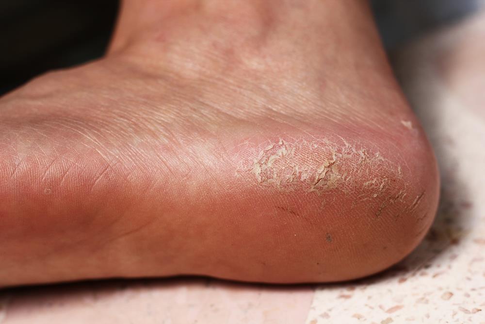 Calluses Albany, NY